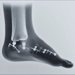 medical titanium alloys